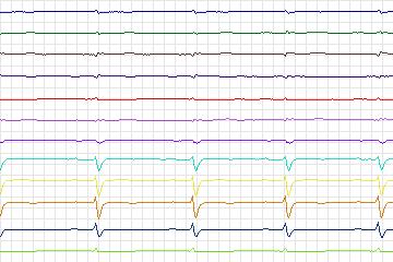 Electrocardiogram for PTB Diagnostic ECG, record s0423_re-patient201