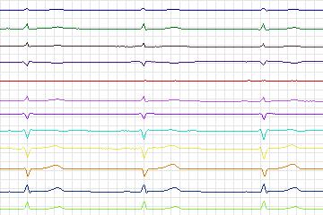 Electrocardiogram for PTB Diagnostic ECG, record s0424_re-patient203