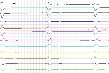 Electrocardiogram for PTB Diagnostic ECG, record s0425_re-patient204