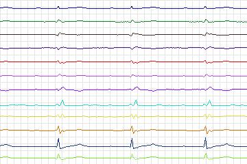 Electrocardiogram for PTB Diagnostic ECG, record s0426_re-patient205