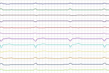 Electrocardiogram for PTB Diagnostic ECG, record s0428_re-patient207