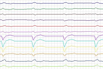 Electrocardiogram for PTB Diagnostic ECG, record s0429_re-patient208