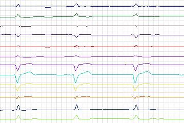 Electrocardiogram for PTB Diagnostic ECG, record s0430_re-patient208