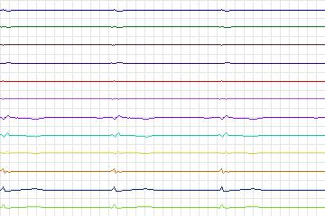 Electrocardiogram for PTB Diagnostic ECG, record s0431_re-patient209