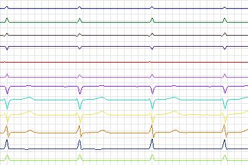 Electrocardiogram for PTB Diagnostic ECG, record s0432_re-patient210
