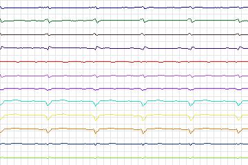Electrocardiogram for PTB Diagnostic ECG, record s0433_re-patient211