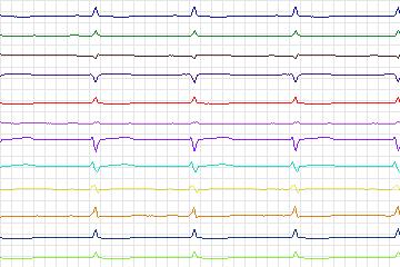 Electrocardiogram for PTB Diagnostic ECG, record s0434_re-patient212