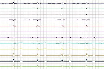 Electrocardiogram for PTB Diagnostic ECG, record s0435_re-patient213