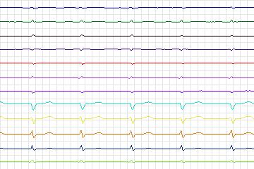 Electrocardiogram for PTB Diagnostic ECG, record s0436_re-patient214