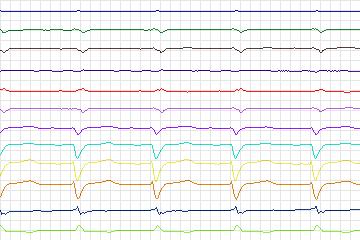 Electrocardiogram for PTB Diagnostic ECG, record s0437_re-patient215