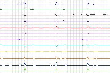 Electrocardiogram for PTB Diagnostic ECG, record s0438_re-patient216