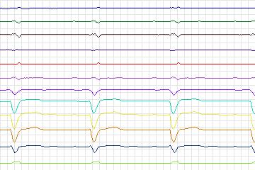 Electrocardiogram for PTB Diagnostic ECG, record s0439_re-patient217