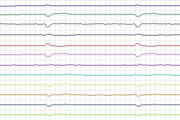 Electrocardiogram for PTB Diagnostic ECG, record s0440_re-patient218