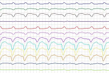 Electrocardiogram for PTB Diagnostic ECG, record s0441_re-patient219