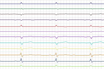 Electrocardiogram for PTB Diagnostic ECG, record s0443_re-patient221