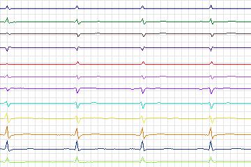 Electrocardiogram for PTB Diagnostic ECG, record s0444_re-patient222