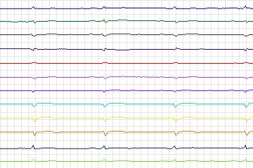 Electrocardiogram for PTB Diagnostic ECG, record s0445_re-patient223