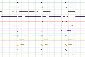 Electrocardiogram for PTB Diagnostic ECG, record s0446_re-patient223