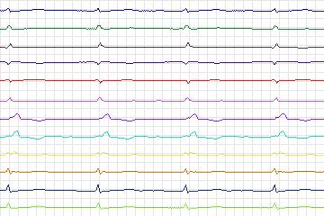 Electrocardiogram for PTB Diagnostic ECG, record s0447_re-patient224