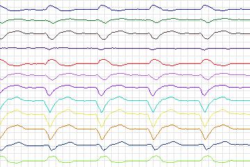 Electrocardiogram for PTB Diagnostic ECG, record s0448_re-patient225