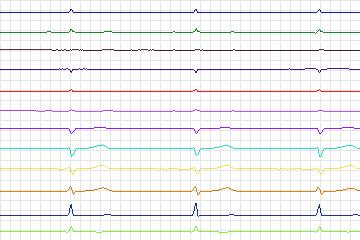Electrocardiogram for PTB Diagnostic ECG, record s0449_re-patient226