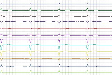 Electrocardiogram for PTB Diagnostic ECG, record s0450_re-patient227