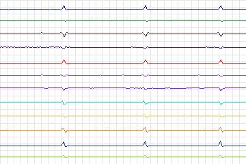 Electrocardiogram for PTB Diagnostic ECG, record s0451_re-patient228