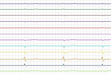 Electrocardiogram for PTB Diagnostic ECG, record s0452_re-patient229