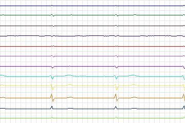 Electrocardiogram for PTB Diagnostic ECG, record s0453_re-patient229
