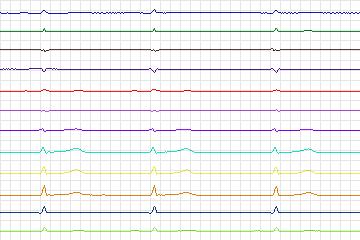 Electrocardiogram for PTB Diagnostic ECG, record s0454_re-patient230