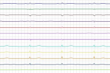 Electrocardiogram for PTB Diagnostic ECG, record s0455_re-patient231
