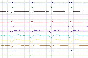 Electrocardiogram for PTB Diagnostic ECG, record s0456_re-patient232
