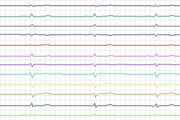 Electrocardiogram for PTB Diagnostic ECG, record s0457_re-patient233