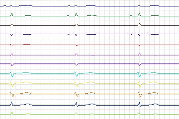 Electrocardiogram for PTB Diagnostic ECG, record s0458_re-patient233