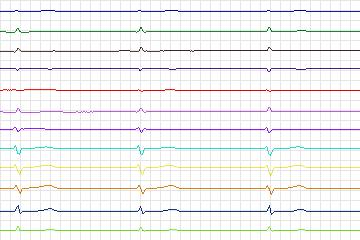 Electrocardiogram for PTB Diagnostic ECG, record s0459_re-patient233