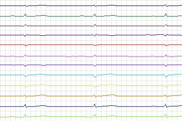 Electrocardiogram for PTB Diagnostic ECG, record s0460_re-patient234