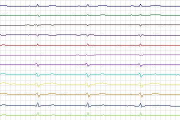 Electrocardiogram for PTB Diagnostic ECG, record s0461_re-patient235