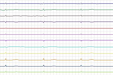 Electrocardiogram for PTB Diagnostic ECG, record s0462_re-patient236
