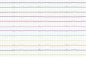 Electrocardiogram for PTB Diagnostic ECG, record s0463_re-patient236