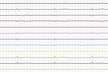 Electrocardiogram for PTB Diagnostic ECG, record s0464_re-patient236