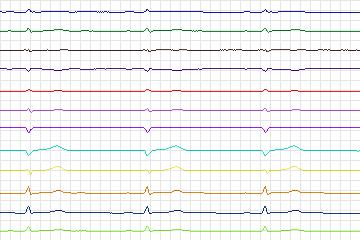 Electrocardiogram for PTB Diagnostic ECG, record s0465_re-patient237