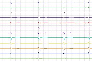 Electrocardiogram for PTB Diagnostic ECG, record s0466_re-patient238