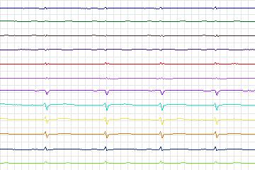 Electrocardiogram for PTB Diagnostic ECG, record s0467_re-patient239
