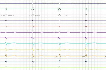 Electrocardiogram for PTB Diagnostic ECG, record s0468_re-patient240