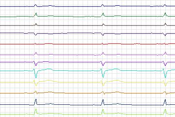 Electrocardiogram for PTB Diagnostic ECG, record s0469_re-patient241