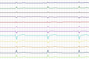 Electrocardiogram for PTB Diagnostic ECG, record s0470_re-patient241