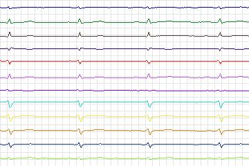 Electrocardiogram for PTB Diagnostic ECG, record s0471_re-patient242
