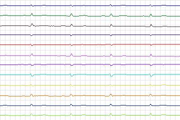 Electrocardiogram for PTB Diagnostic ECG, record s0472_re-patient243