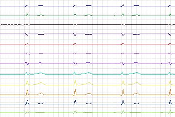Electrocardiogram for PTB Diagnostic ECG, record s0473_re-patient244