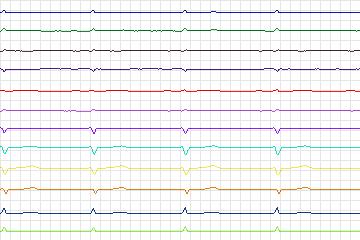 Electrocardiogram for PTB Diagnostic ECG, record s0474_re-patient245